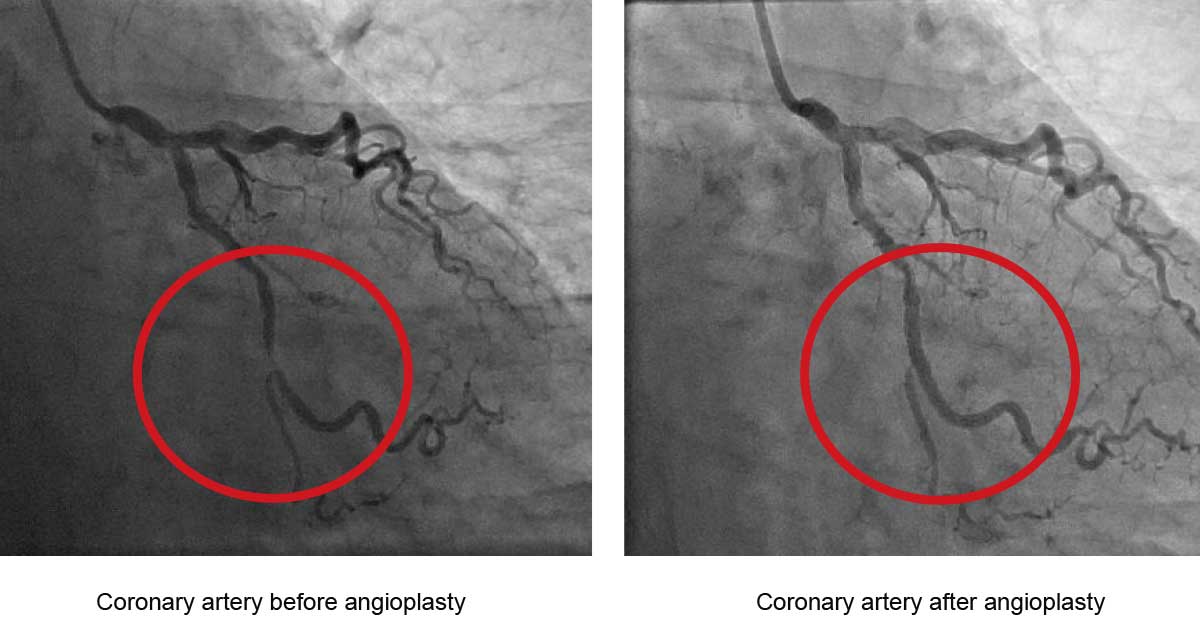 the-difference-angioplasty-makes